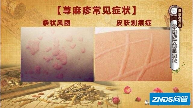 有没有像我被慢性荨麻疹折磨两年的朋友，吃药打针都不断根？