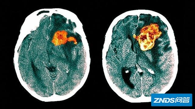 得了膠質母細胞瘤惡性腦腫瘤可以活多久