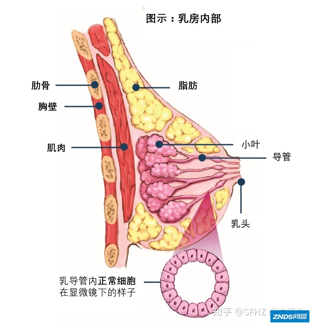 一文读懂乳腺癌的病理报告-2.jpg