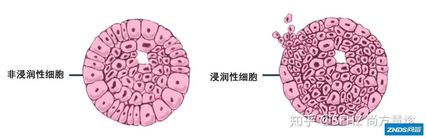 一文读懂乳腺癌的病理报告-3.jpg