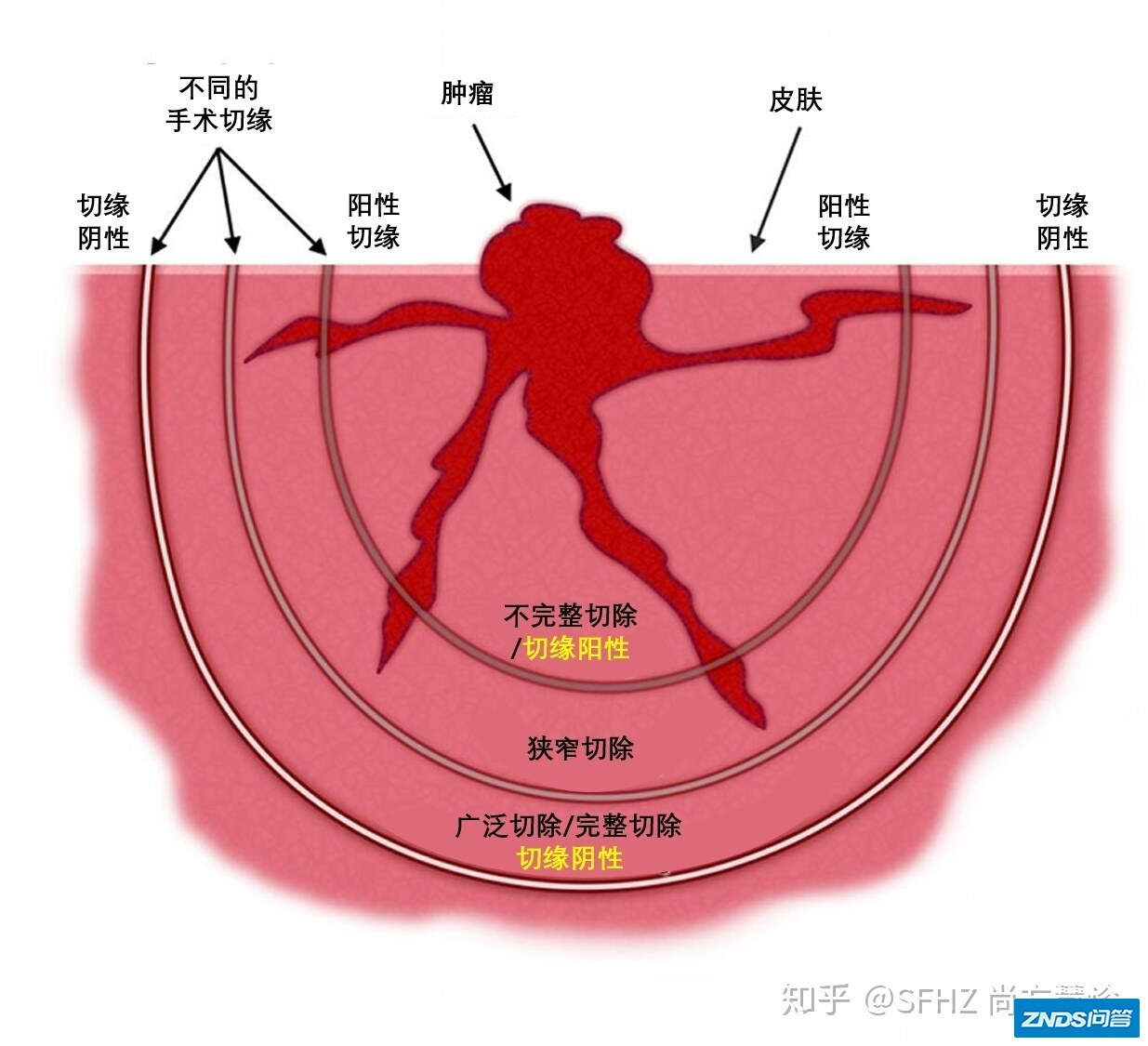 一文读懂乳腺癌的病理报告-6.jpg