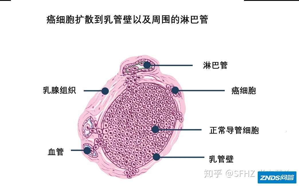 一文读懂乳腺癌的病理报告-11.jpg