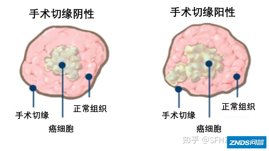 一文读懂乳腺癌的病理报告-7.jpg